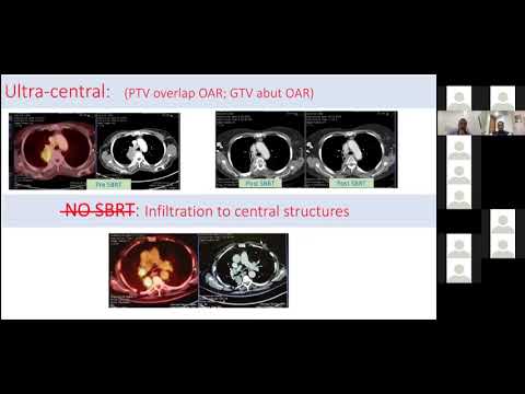  Lung Radiosurgery Overview 